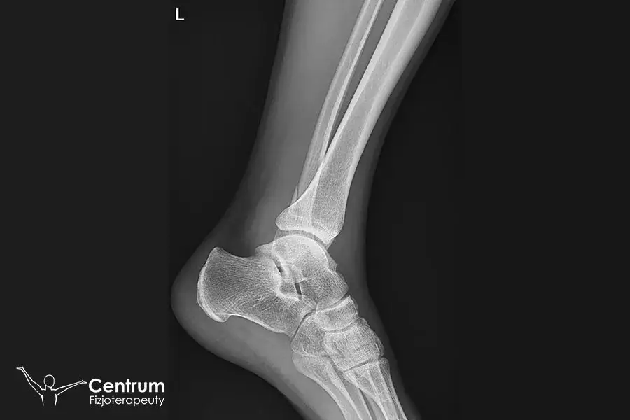 Rehabilitacja po złamaniu kostki: Ile trwa i jak wrócić do formy?