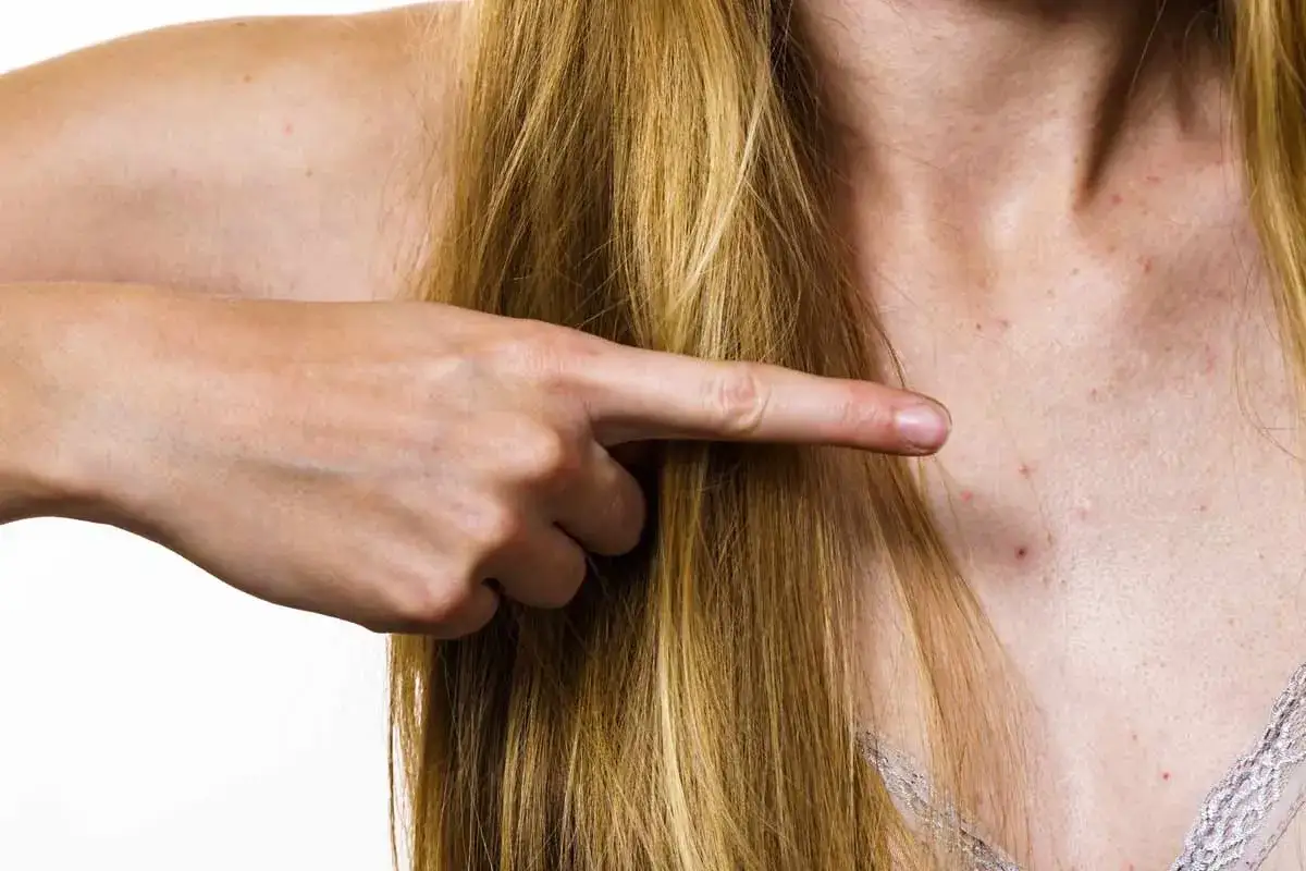 Pryszcze na dekolcie? Jak skutecznie się ich pozbyć poradnik