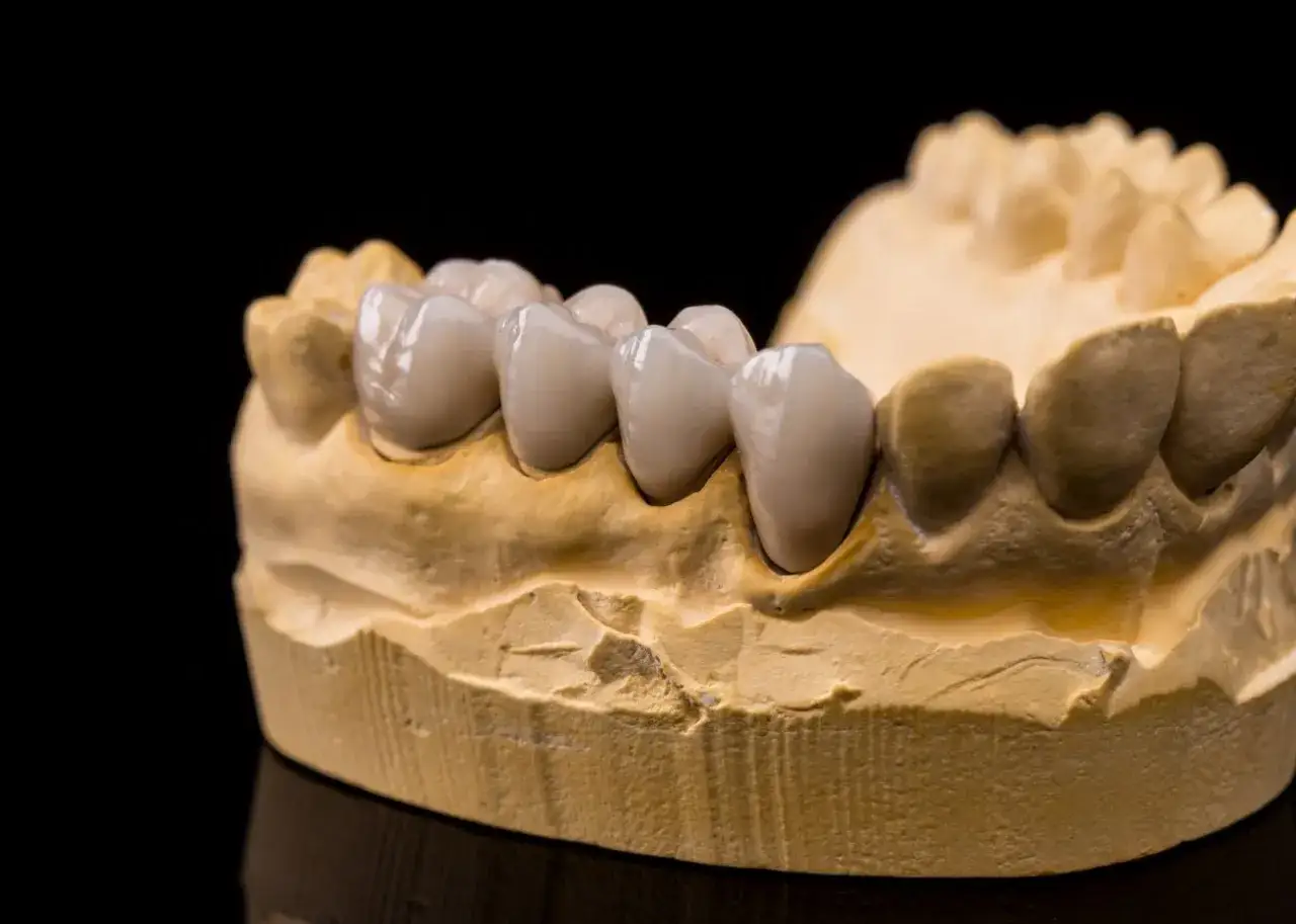 Mostek na 1 ząb: od 2700 zł do 10000 zł. Poznaj pełny koszt.