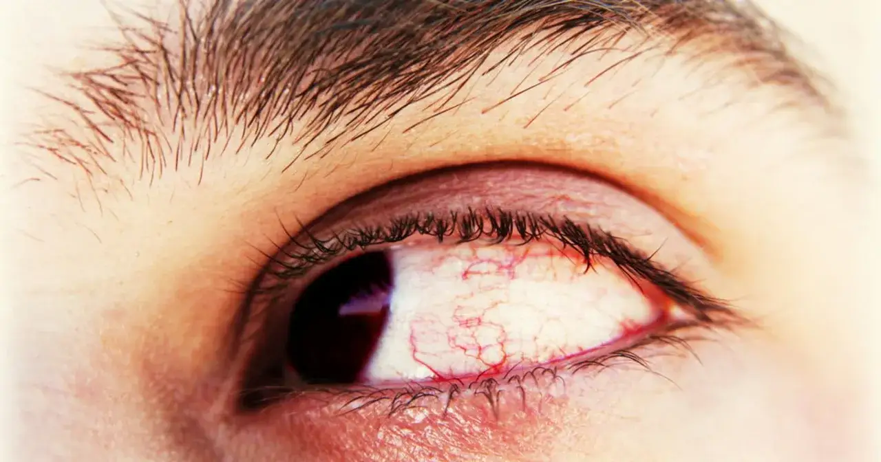 Syndrom widzenia komputerowego: objawy i jak zadbać o wzrok?