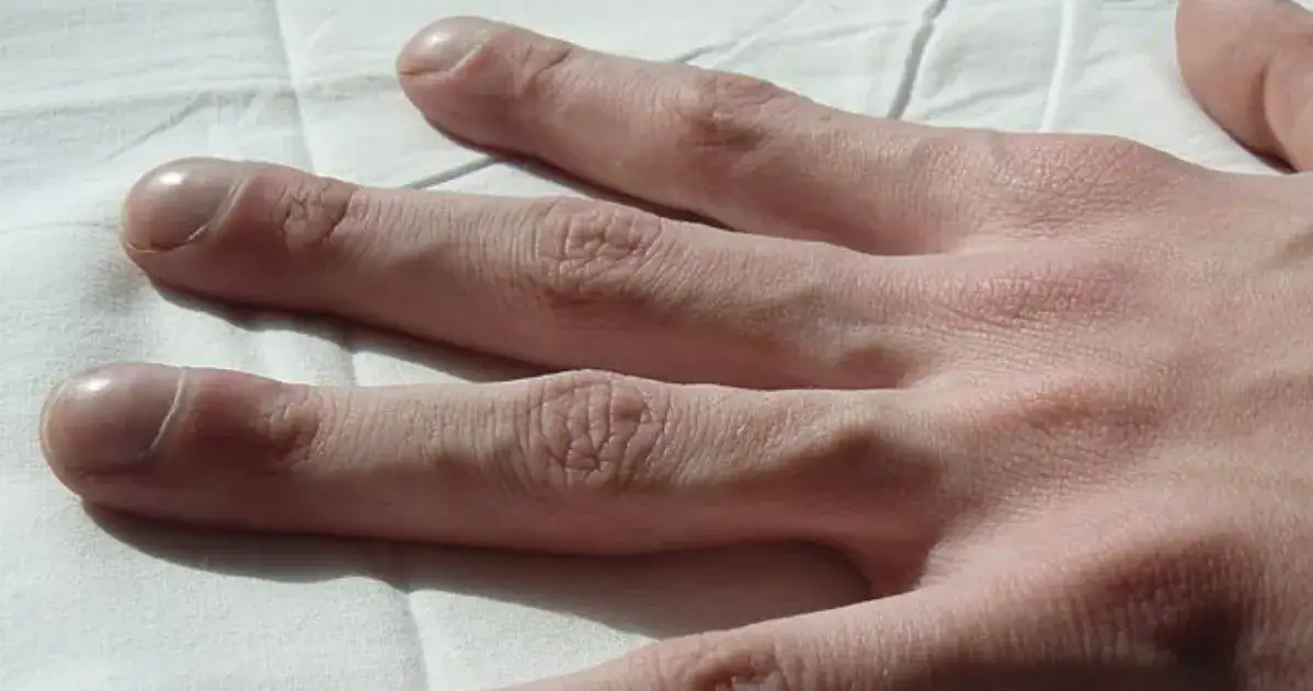 Choroby serca objawy skórne – nie ignoruj tych niebezpiecznych symptomów