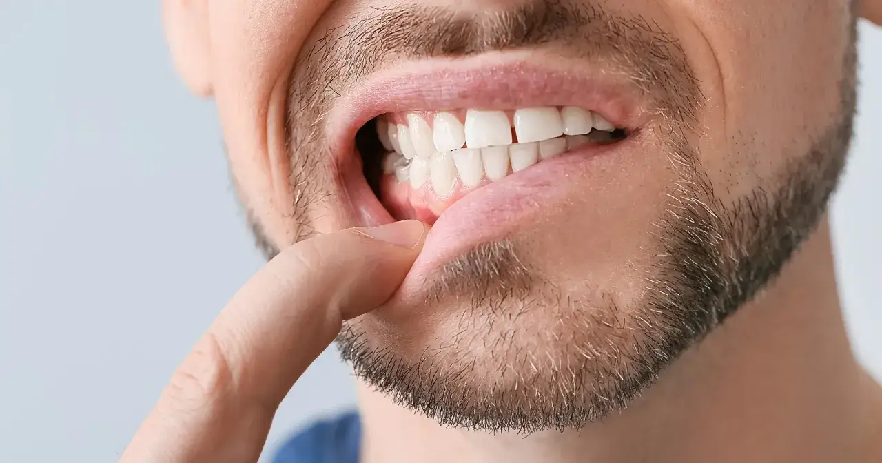 Ropa na dziąśle: Jak bezpiecznie usunąć i kiedy do dentysty?