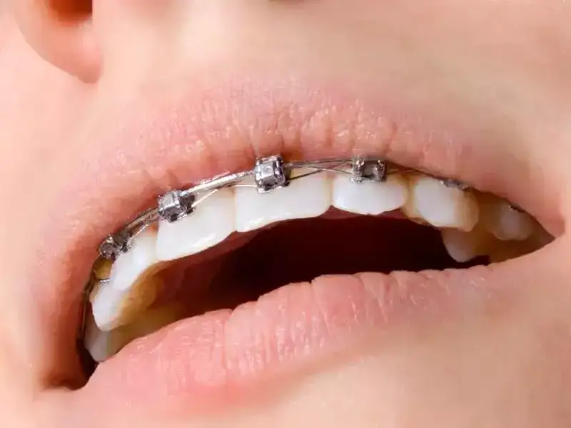 Czy aparat na zęby naprawdę powiększa usta? Fakty i mity o wpływie na wygląd