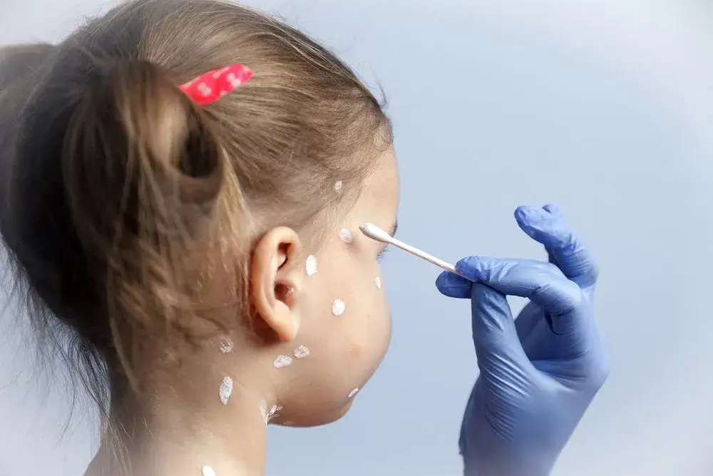 Prawda o maści cynkowej na pryszcze: Kiedy pomoże, a kiedy nie?