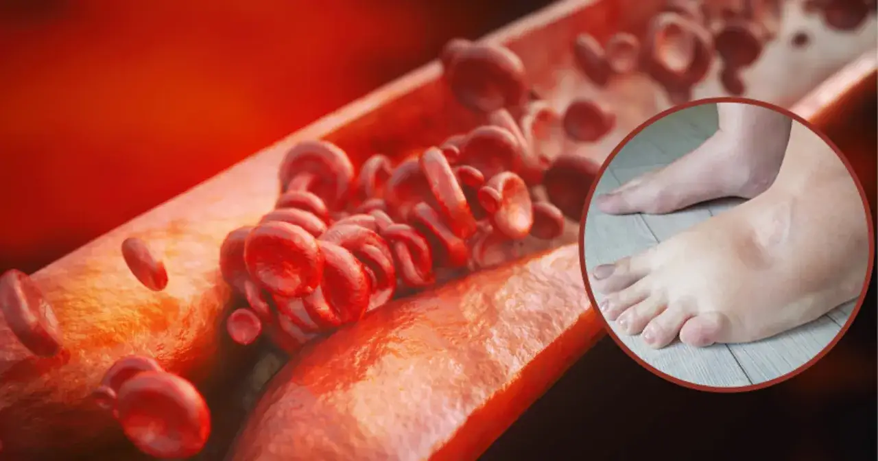 Miażdżyca: Do kogo z objawami? Pełny przewodnik po leczeniu