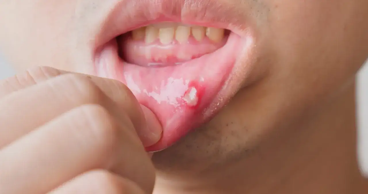 Zapalenie jamy ustnej: Szybka ulga i leczenie co naprawdę działa?
