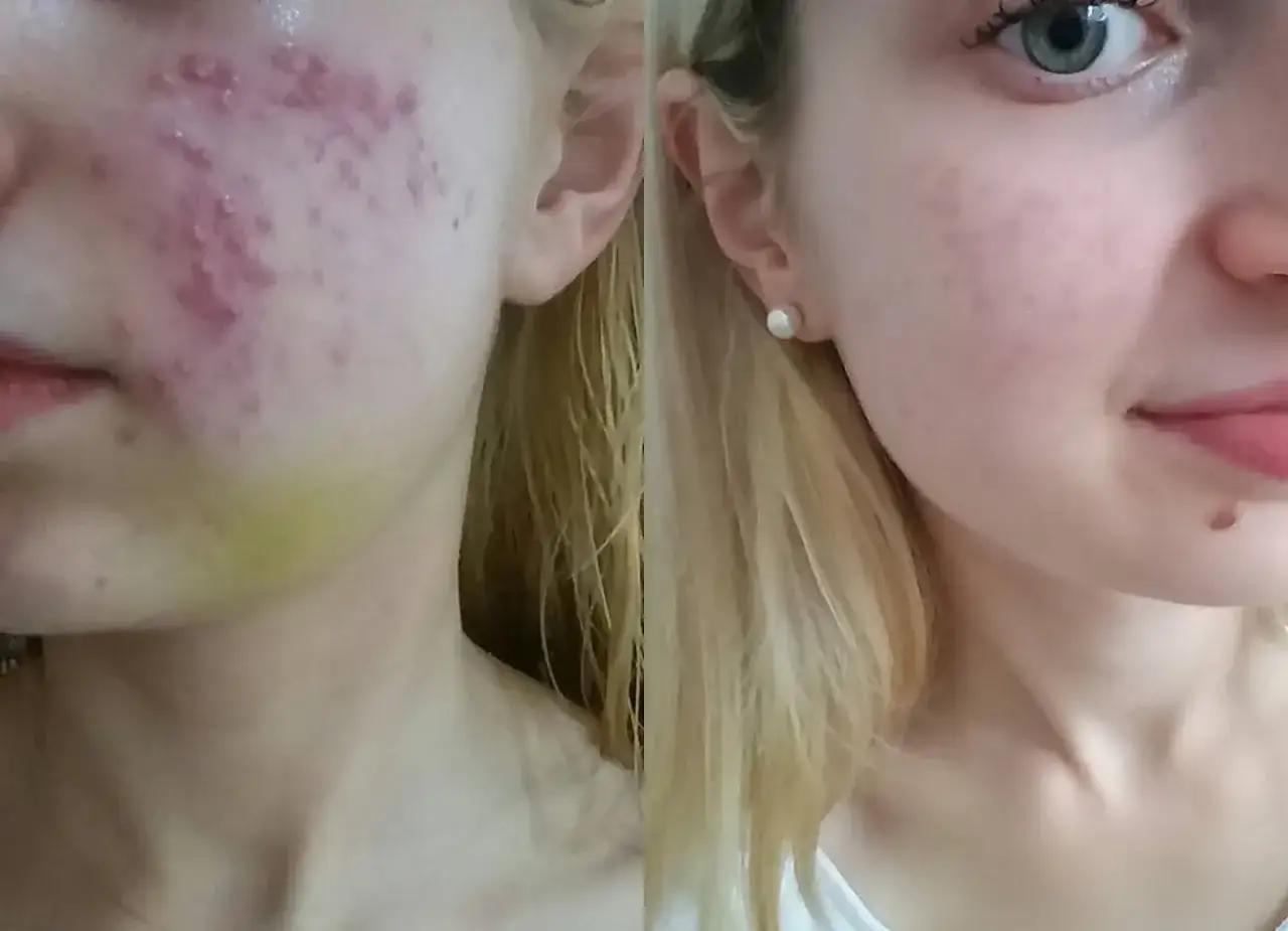 Izotek: Skutki uboczne. Przewodnik i porady eksperta