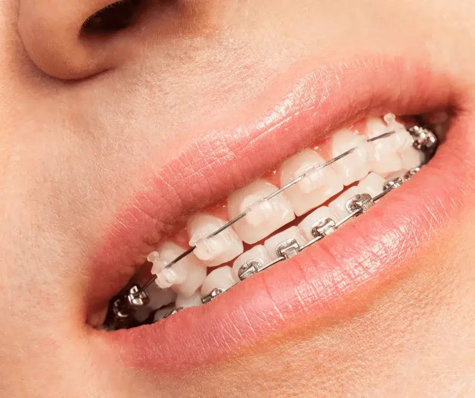 Jak wyglądają aparaty na zęby? Przewodnik po estetyce i dyskrecji