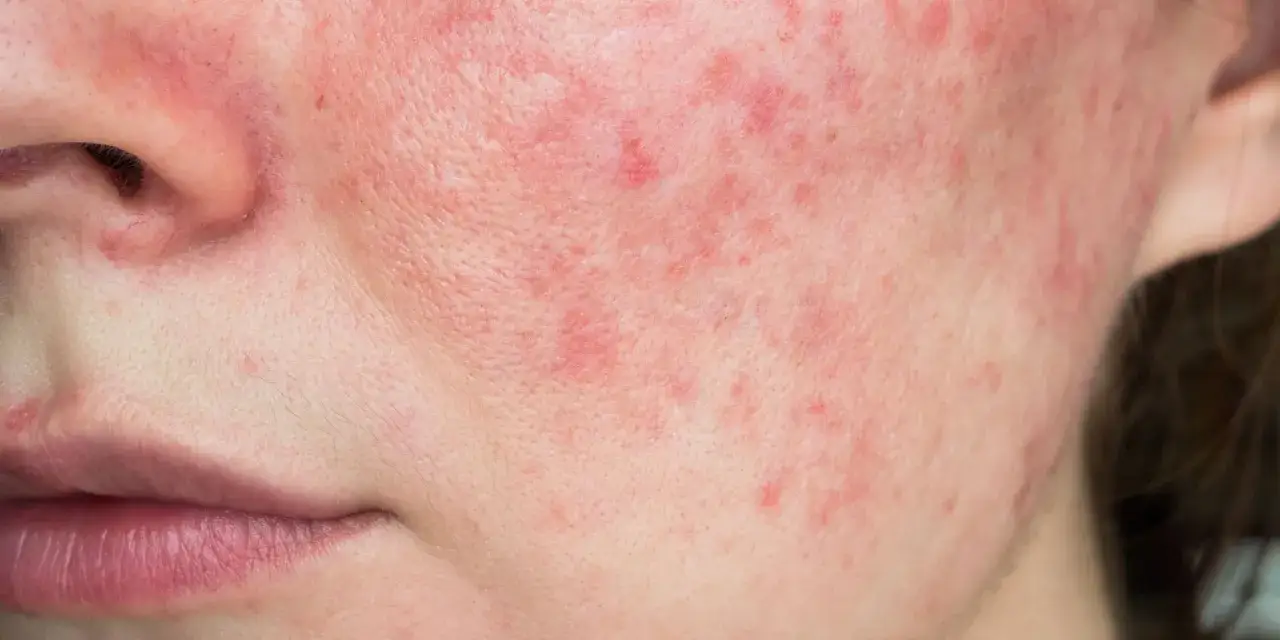 Trądzik różowaty: Pielęgnacja. Co działa, a czego unikać?