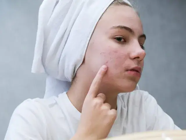 Ile dni przed okresem wyskakują pryszcze i jak ich uniknąć?