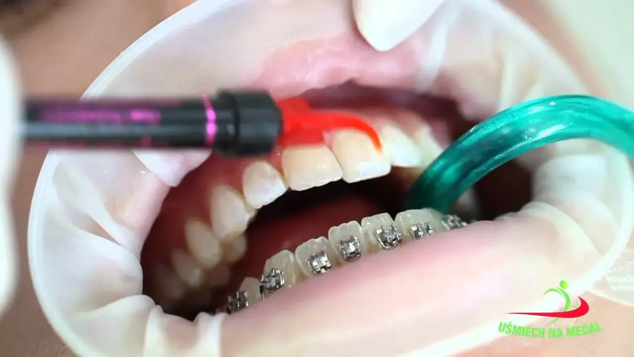 Aparat na zęby: jak się zakłada? Bez bólu, krok po kroku!