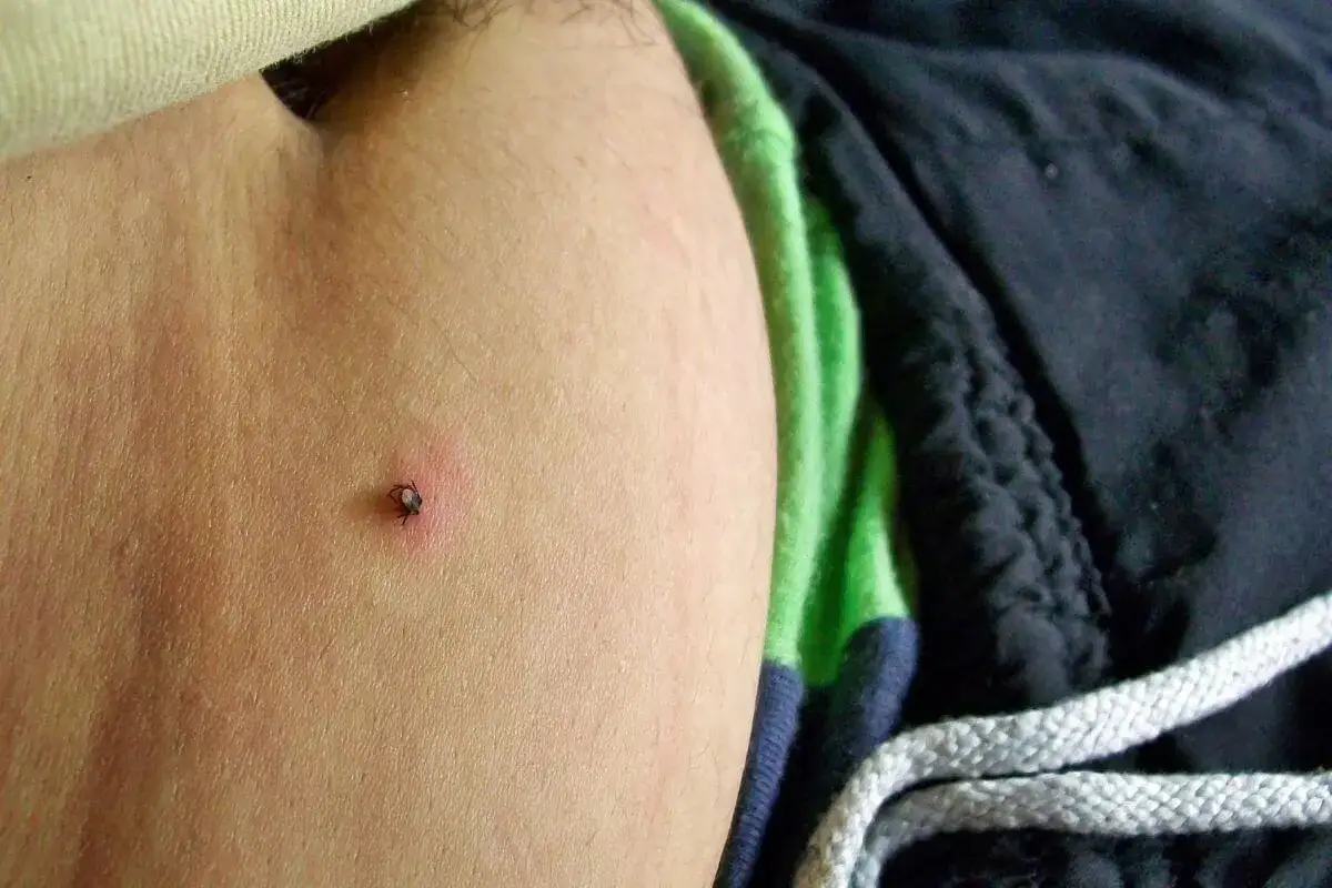 Kleszcz pod skórą: Czy to groźne? Objawy, KZM, rumień poradnik