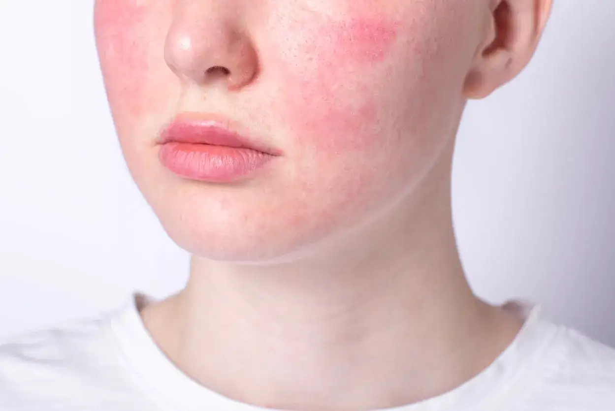 Jak rozpoznać cerę wrażliwą? Objawy i proste testy dla Ciebie