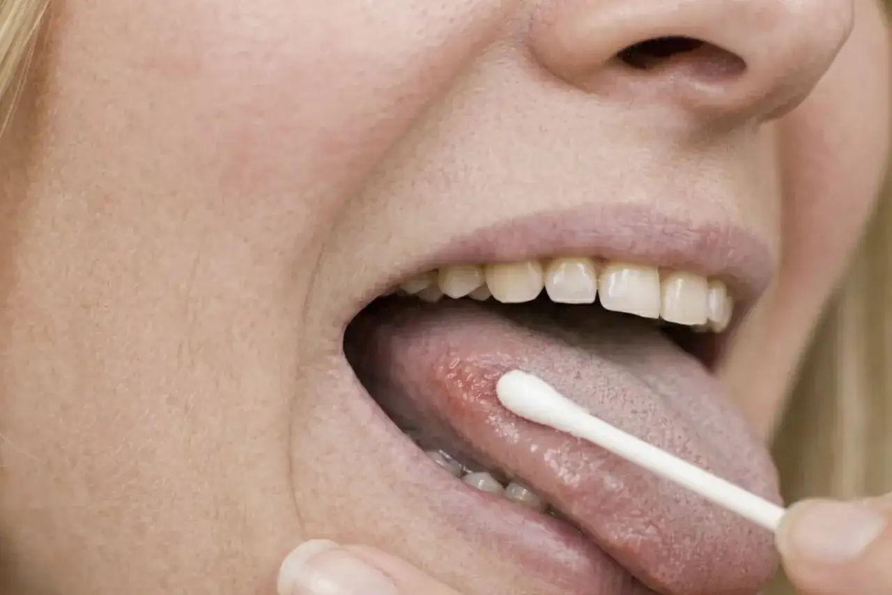 Ktoś aplikuje lek na aftę na języku za pomocą patyczka kosmetycznego. Szybkie sposoby, jak pozbyć się afty.