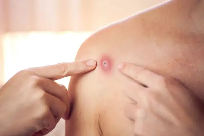 Jak wyciskać pryszcze bez ryzyka blizn i infekcji skóry