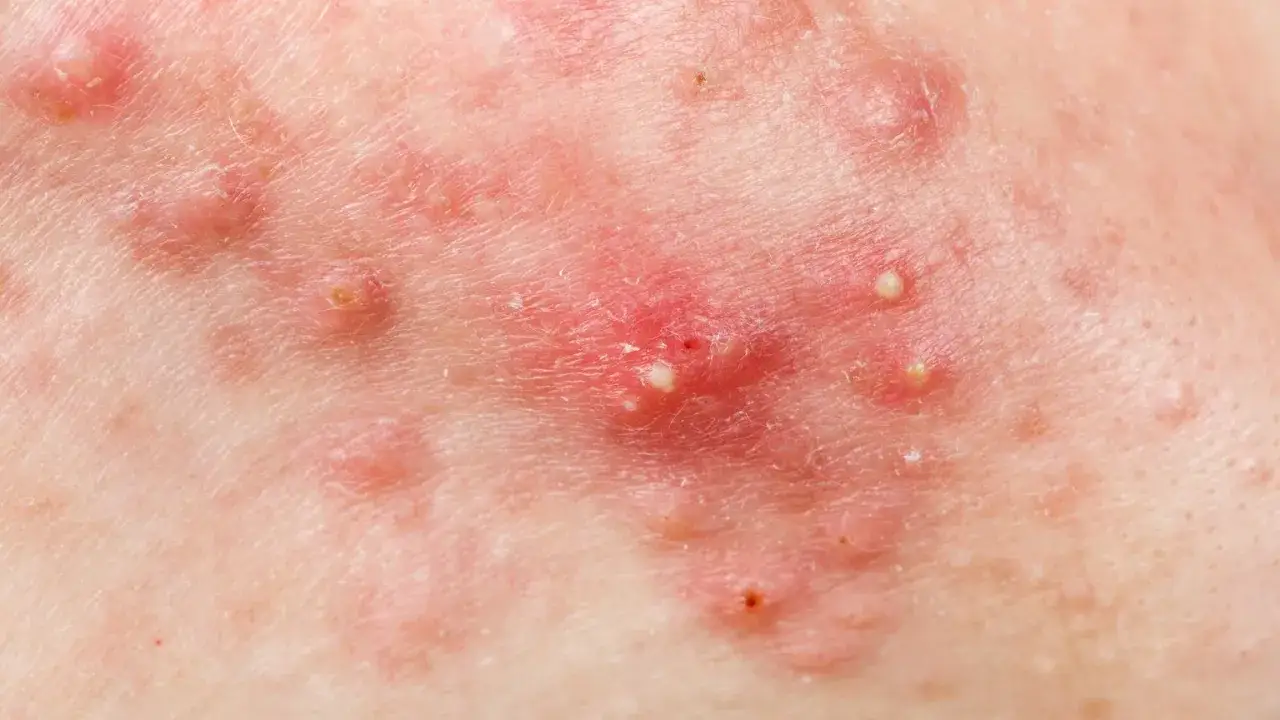 Wyciskanie pryszczy: Kiedy możesz, a kiedy musisz odpuścić?