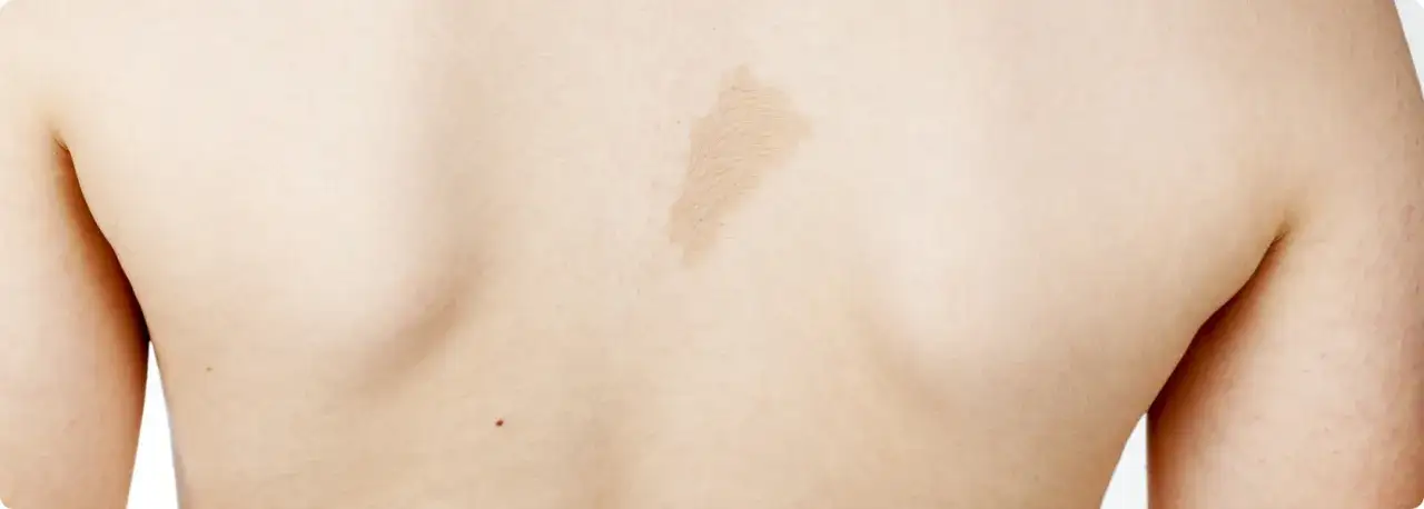 Milchkaffee Fleck: Ursachen, Behandlung und wichtige Informationen