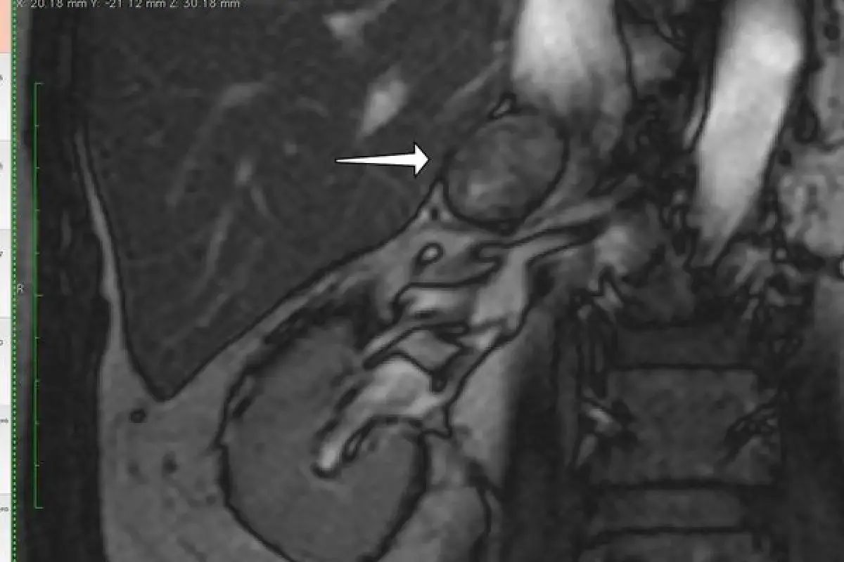 Guz nadnercza: Do jakiego lekarza się udać? Twój przewodnik