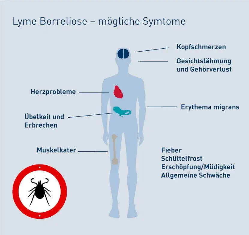 Borreliose Symptome: So erkennen Sie die Anzeichen einer Zeckeninfektion