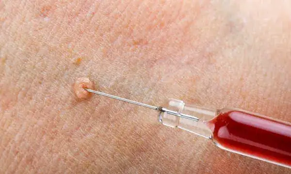 Kłykciny kończyste: dermatolog czy urolog? Wybierz właściwego lekarza!