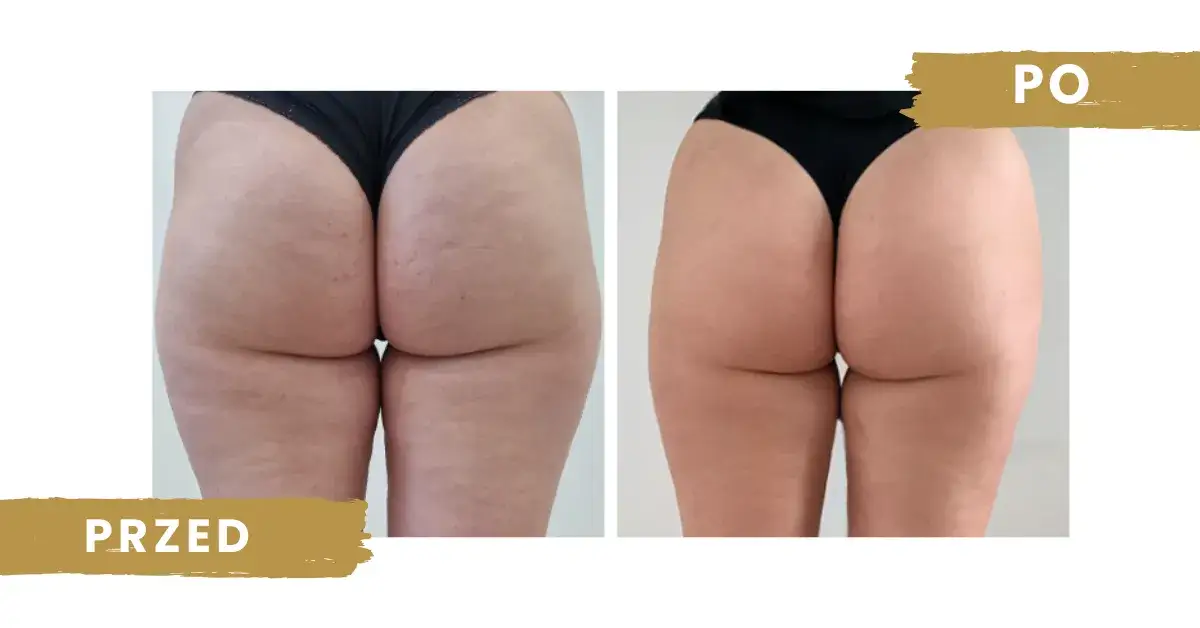 Co daje endermologia? Efekty, które mogą Cię zaskoczyć