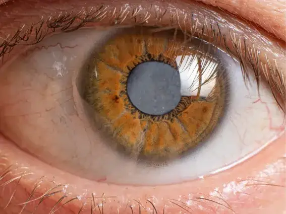 Kiedy czytać po operacji zaćmy? Bezpieczny powrót do książek i ekranów