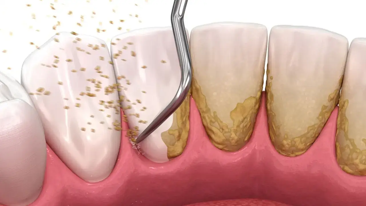 Usuwanie kamienia nazębnego: Bezpiecznie, skutecznie, bez bólu?