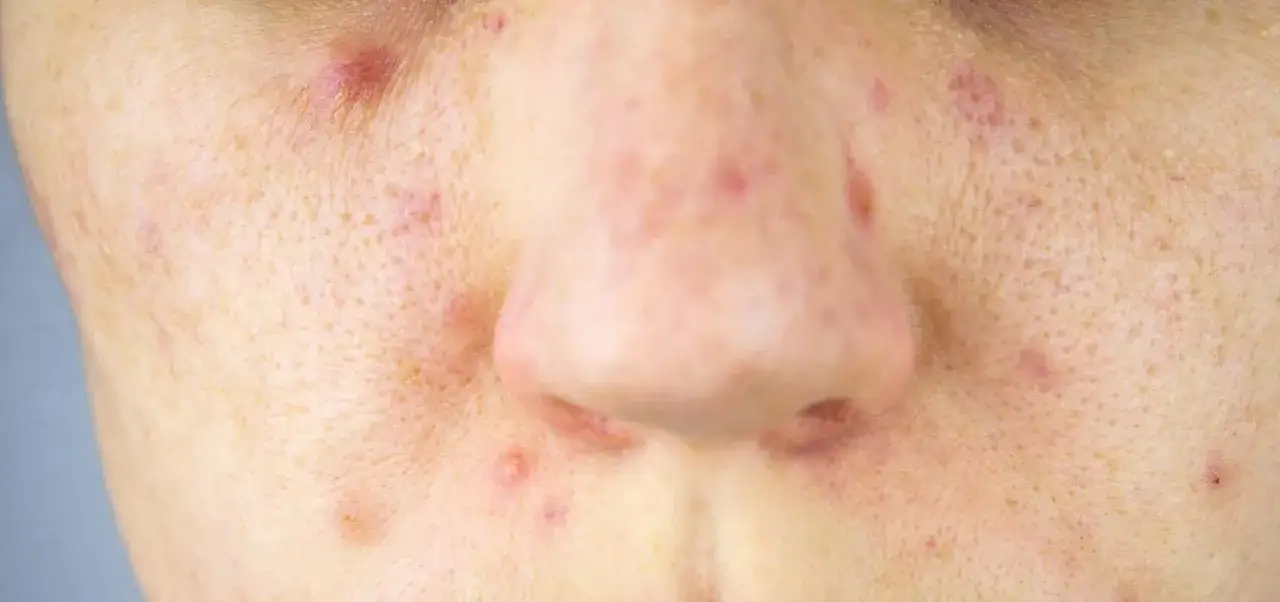 Blizny po pryszczach? Odzyskaj gładką skórę! Poradnik eksperta.