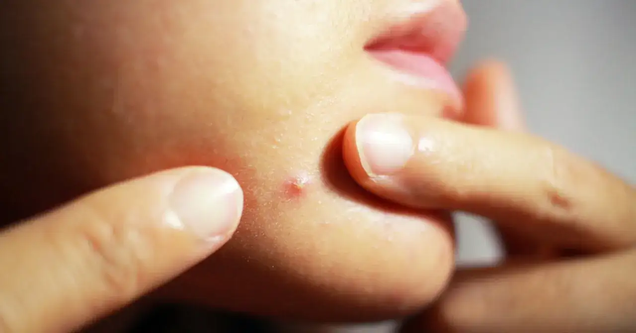 Jak zapobiec pryszczom? Holistyczne podejście do czystej cery