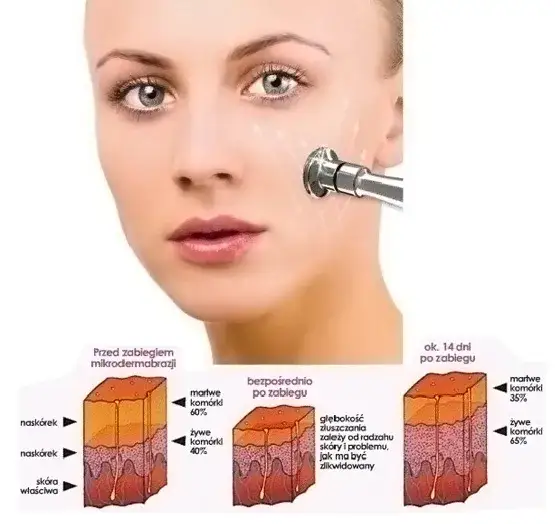 Mikrodermabrazja diamentowa jak często? Odkryj optymalne odstępy