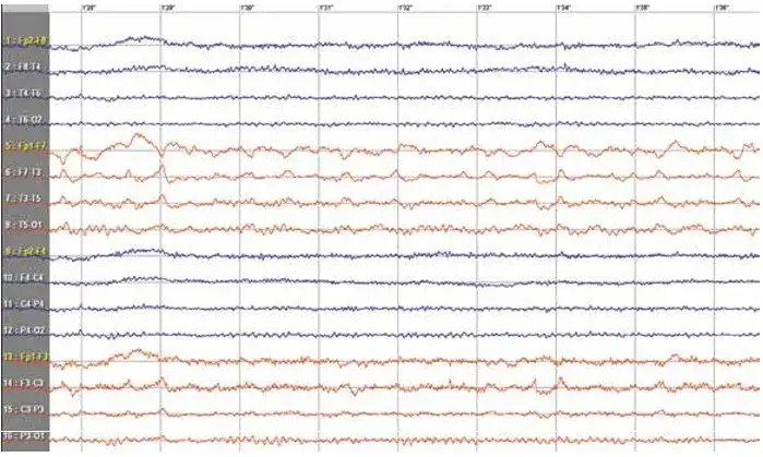 Padaczka skroniowa czy nerwica - jak odróżnić te stany?