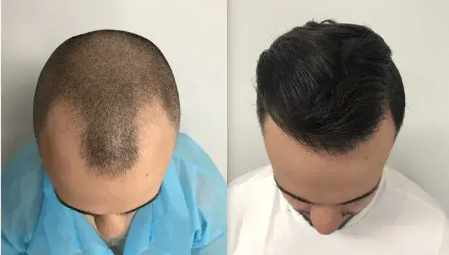 7 fryzur męskich z rzadkimi włosami, które dodadzą im objętości!