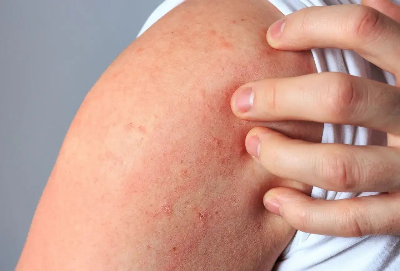 Czerwona swędząca skóra - poznaj przyczyny i najskuteczniejsze metody leczenia