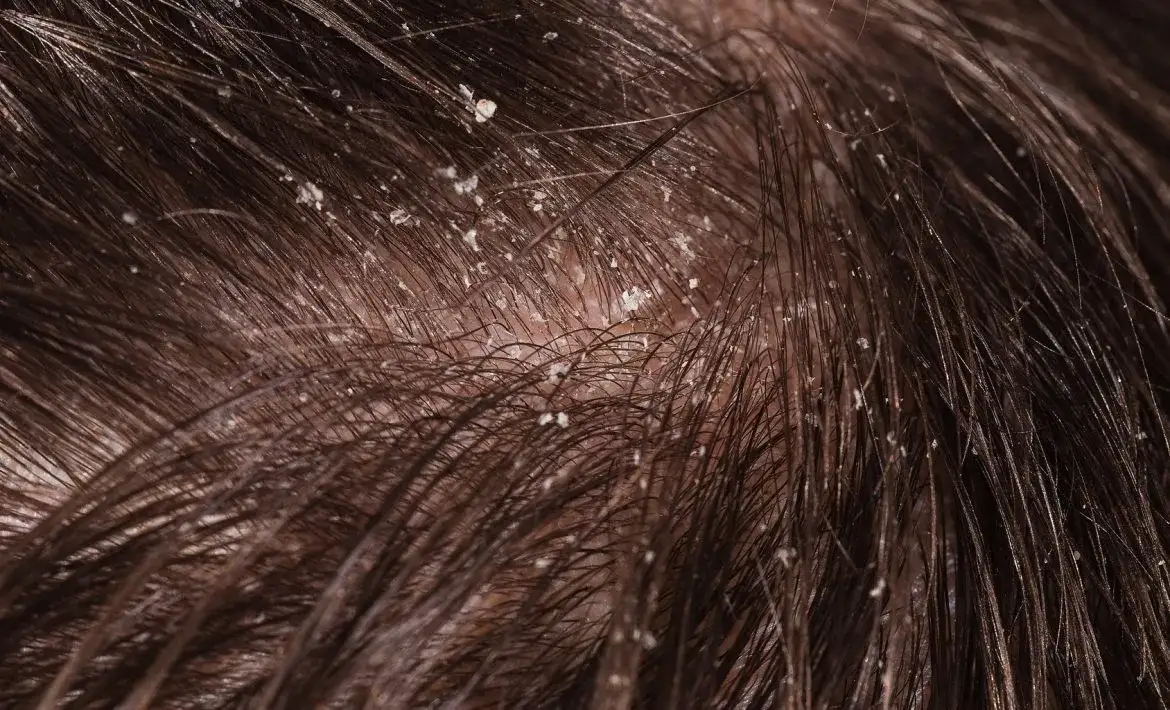 Jak rozpoznać łupież u konia? Objawy, przyczyny i skuteczne sposoby leczenia