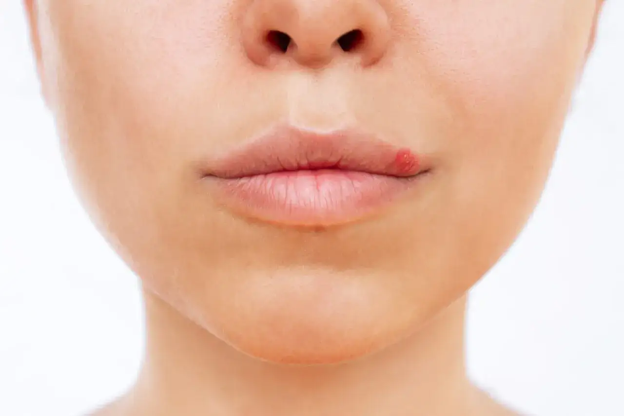 Jak zapobiec opryszczce - skuteczne metody unikania nawrotów