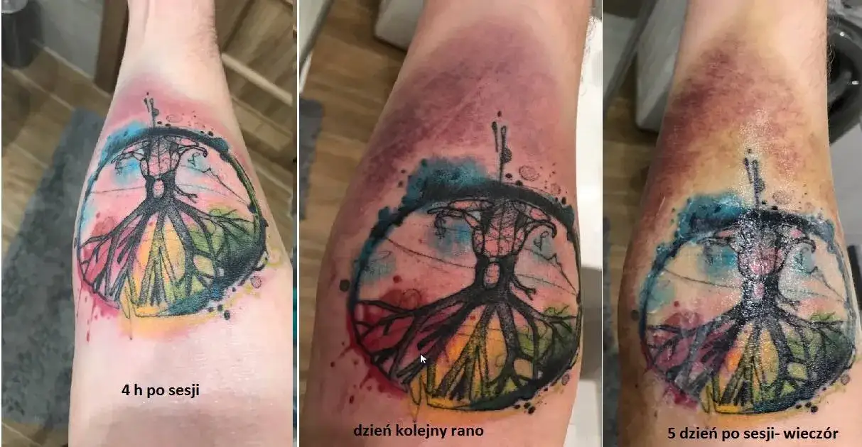 Dlaczego powstają siniaki po tatuażu? Częste przyczyny i profilaktyka