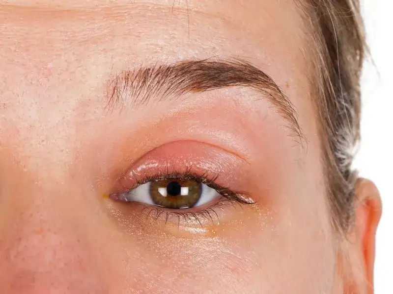 Uczulenie na klej do rzęs – po jakim czasie występuje i jak temu zapobiec