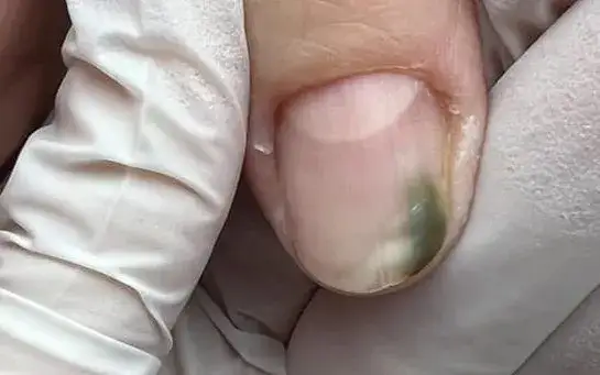 Jak leczyć zieloną bakterię na paznokciu i uniknąć powikłań