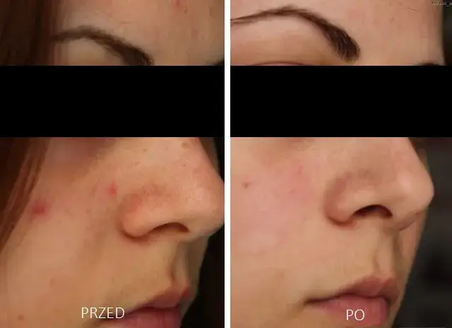 Najskuteczniejsze zabiegi na oczyszczanie twarzy - poznaj 4 sprawdzone metody