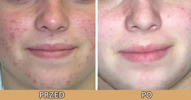 Retinol w kosmetologii: Jak stosować i jakie efekty osiągnąć