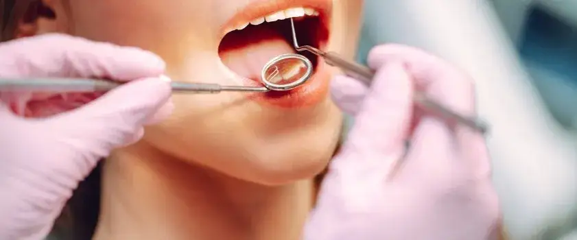 Jak leczyć próchnicę między zębami i uniknąć poważnych problemów