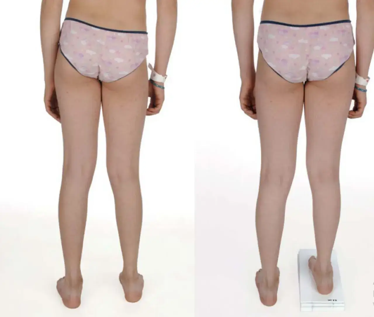 Jedna noga krótsza: przyczyny, objawy i skuteczne leczenie