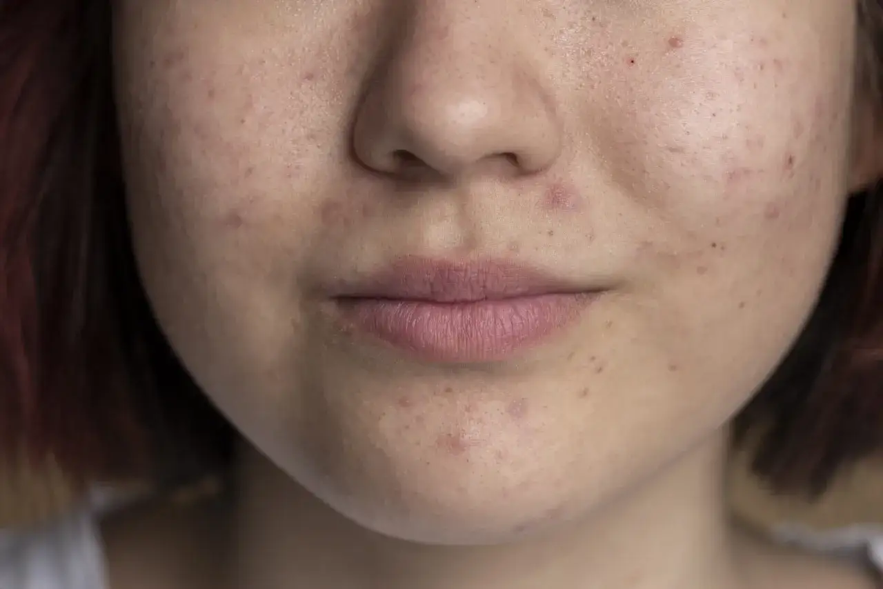 Skuteczne witaminy na cerę trądzikową: klucz do zdrowej skóry