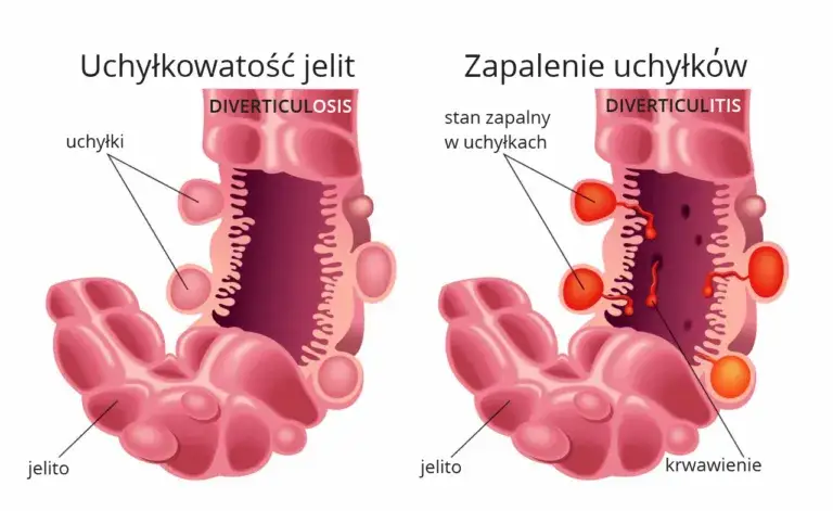 Zapalenie uchyłka jelita objawy - rozpoznaj ból i inne symptomy