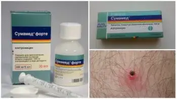 Jaki antybiotyk po ukąszeniu kleszcza? Poznaj ważne informacje!