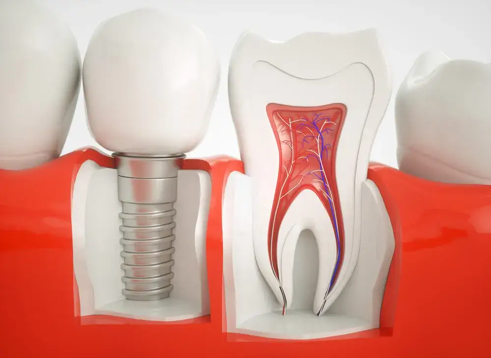 Ile kosztuje odbudowa zęba jedynki? Poznaj ceny i czynniki