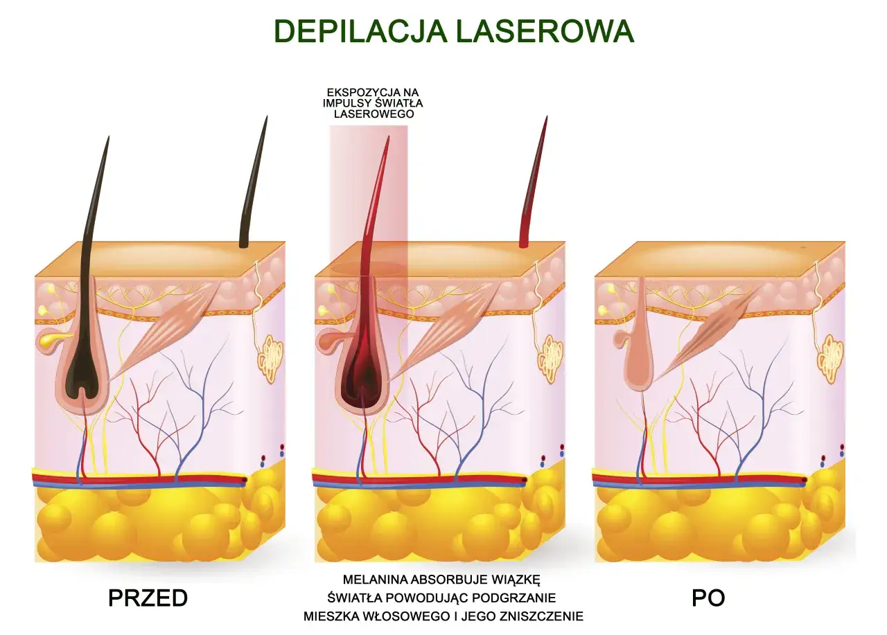 Ilustracja pokazuje laserowe usuwanie wąsika: przed zabiegiem, ekspozycję na laser i efekt po.