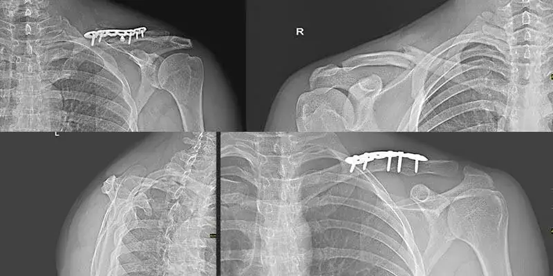 Ile trwa rehabilitacja po złamaniu obojczyka i co warto wiedzieć?