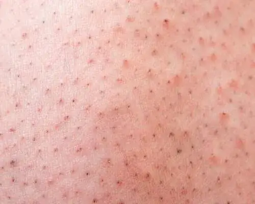 Jak pozbyć się kropek po goleniu i cieszyć się gładką skórą