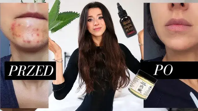 Jak ukryć pryszcze bez makijażu – skuteczne sposoby na naturalne piękno